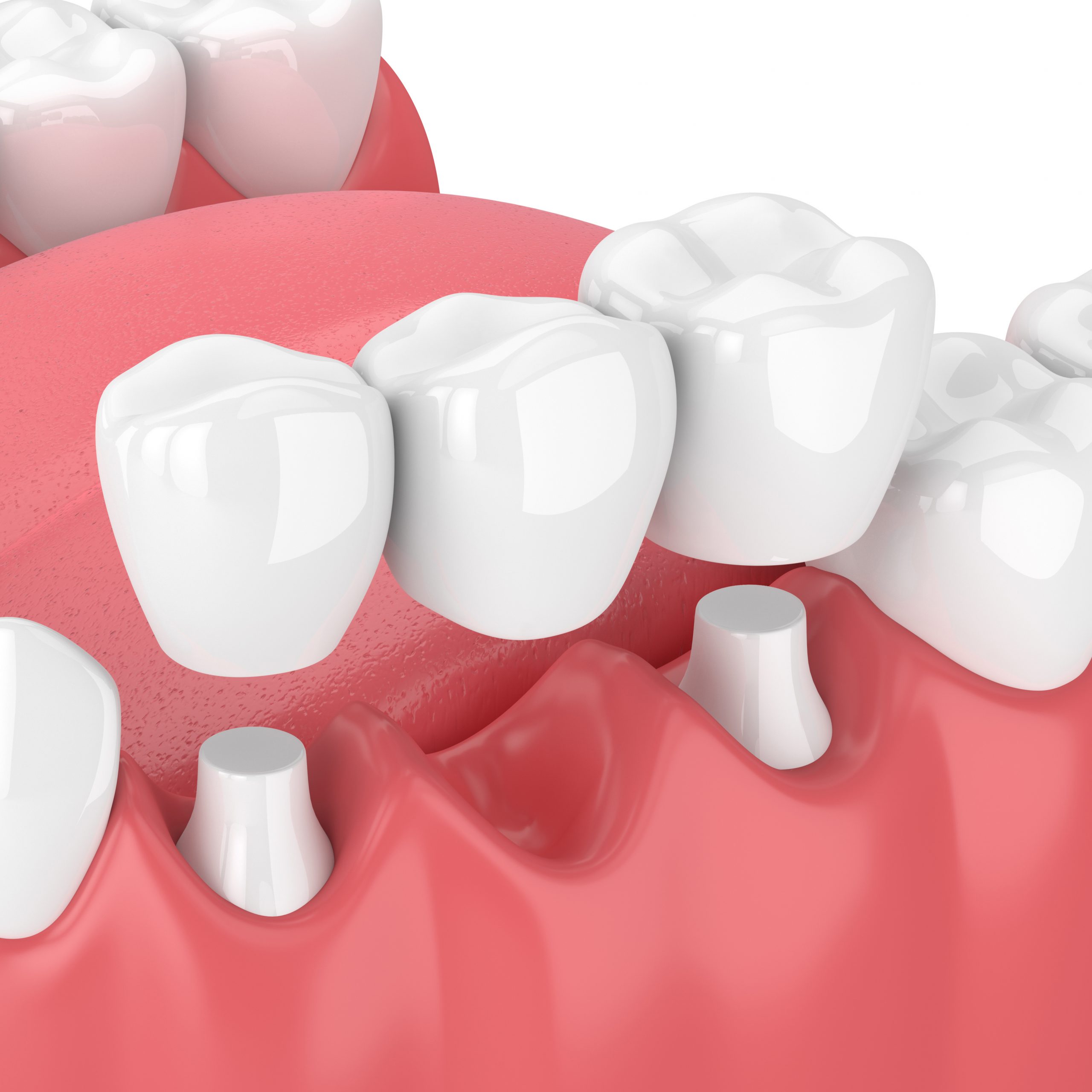 3d render of jaw with dental bridge over white background