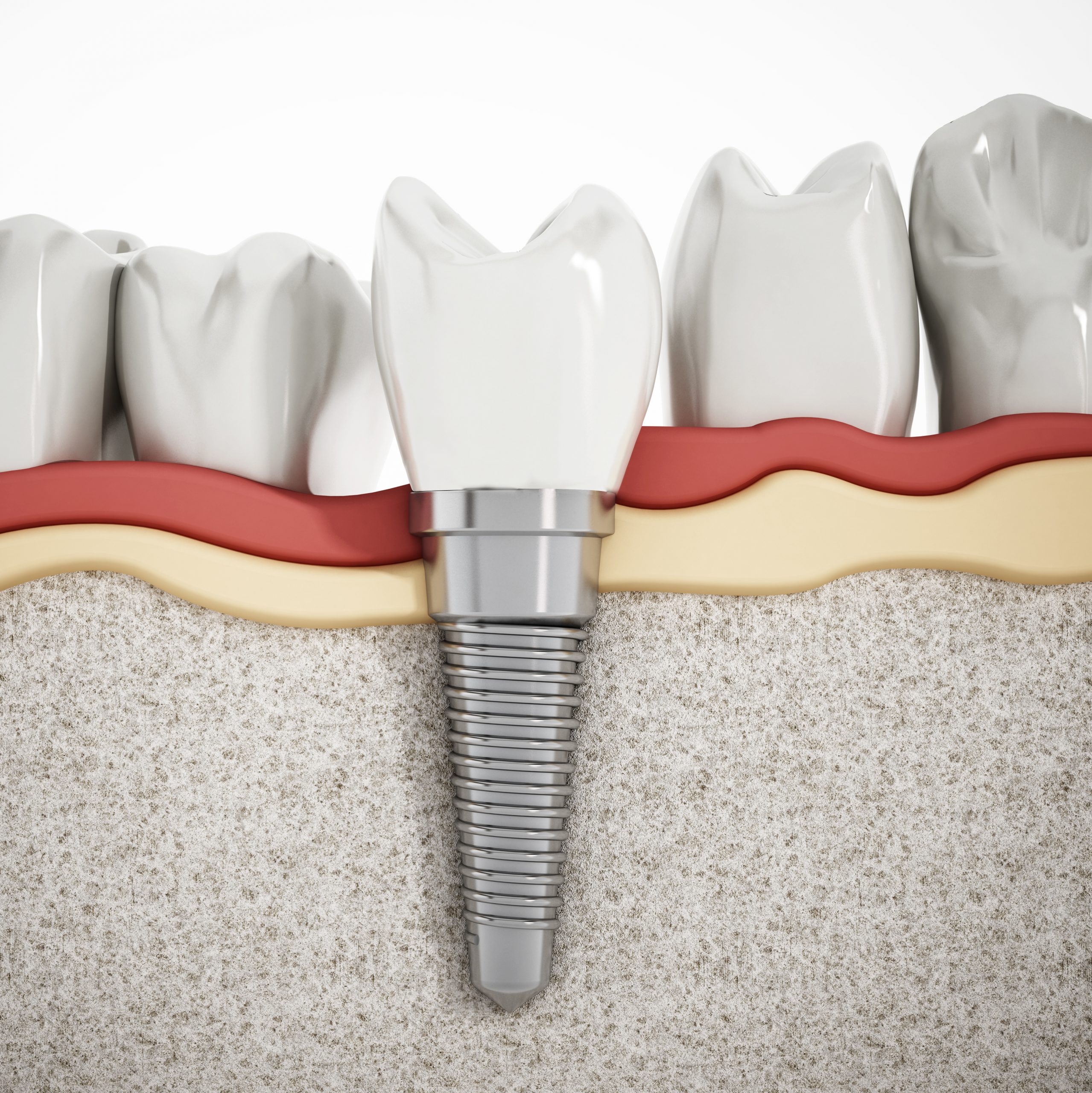 Illustration of teeth showing dental implant structure