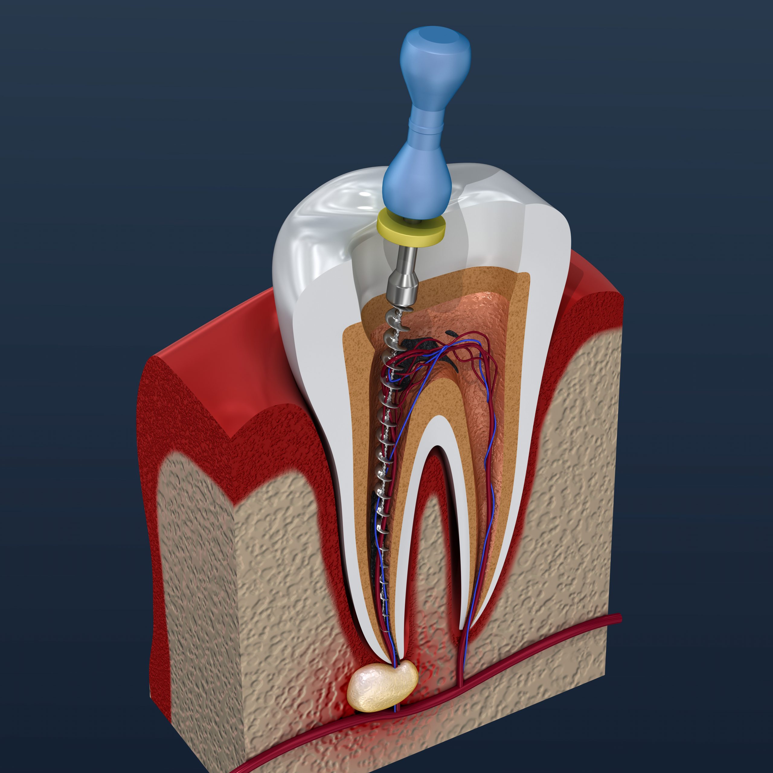 Root canal treatment process. 3D illustration