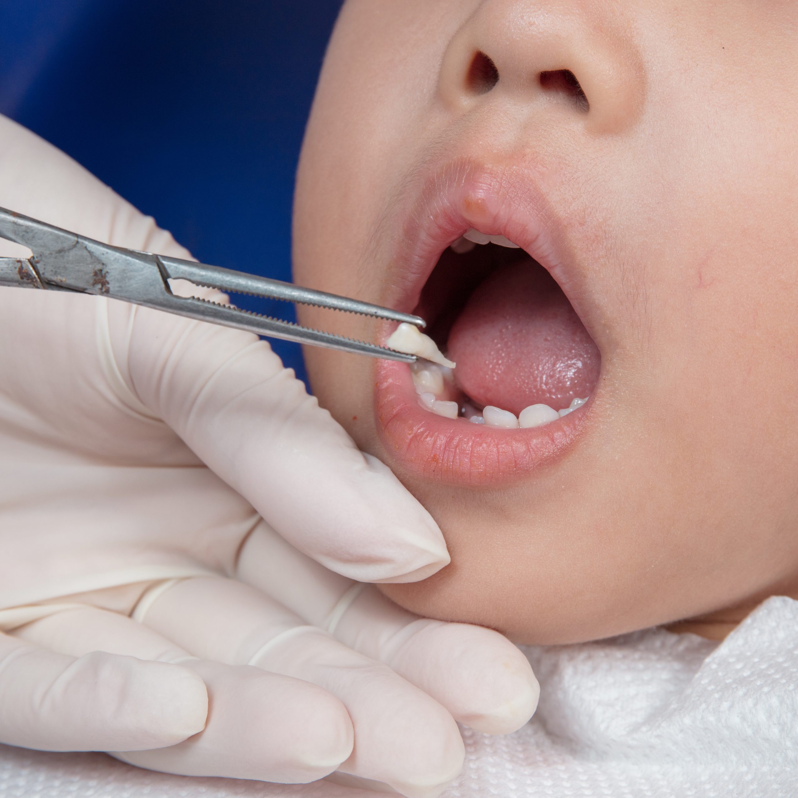 Asian Chinese little girl lying down for tooth extraction at dental clinic