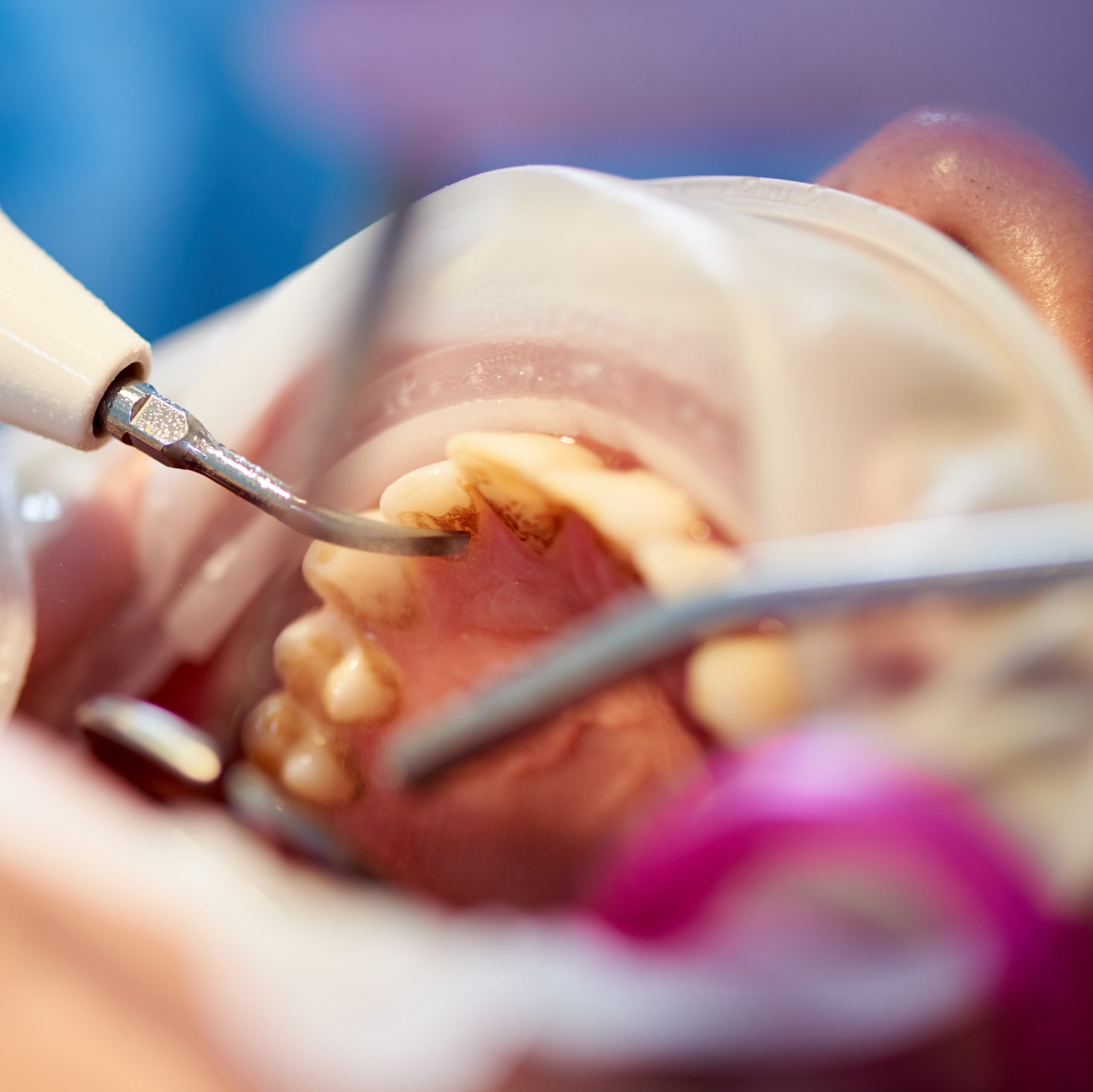 Closeup of client's teeth being scaled and polished in a dental office.